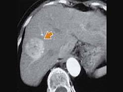 CT造影画像　肝細胞がん