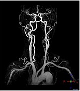 MRI血管系画像