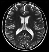 MRI脳神経系画像