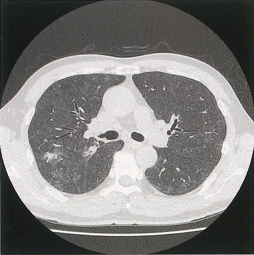 CT肺画像