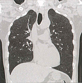 CT肺画像
