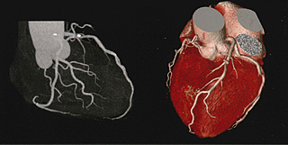 CT心臓画像