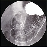 X線胃画像