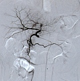 X線腹部血管画像