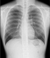 X線胸部画像