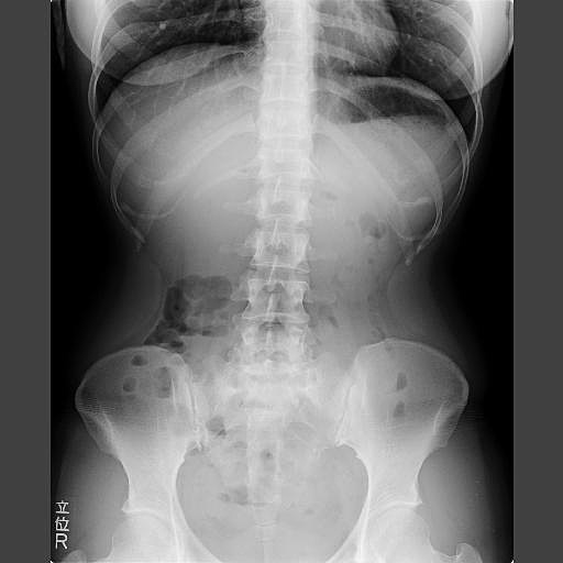 X線腹部画像
