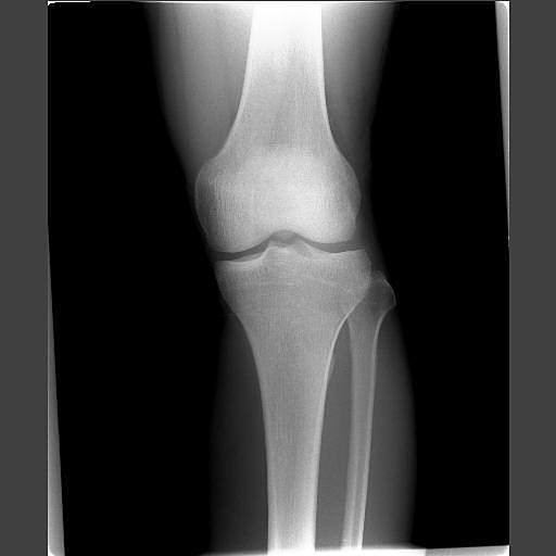 X線膝関節画像