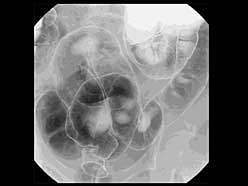 大腸透視検査撮影画像