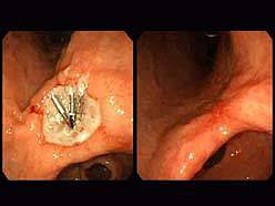 出血性胃潰瘍活動期と治癒期の撮影画像