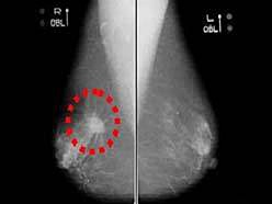 乳房撮影画像　右乳房に乳がんのサインであるスピキュラが写っている