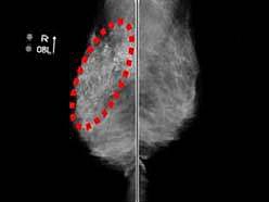 乳房撮影画像　右乳房に石灰化が分布して写っている