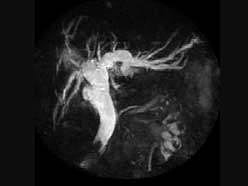 MRI画像　胆道結石
