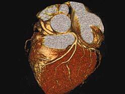 心臓CT撮影画像
