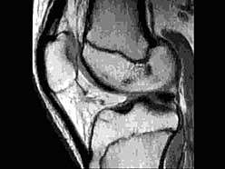 膝関節MRI撮影画像