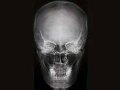 頭部単純X線撮影画像