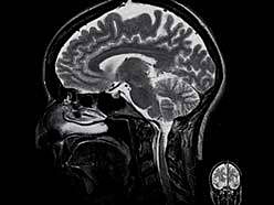 頭部MRI撮影画像