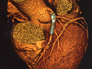 心臓冠動脈のCT画像